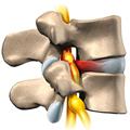 Грыжа позвоночника, межпозвонковая грыжа