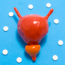 Калькулезный простатит