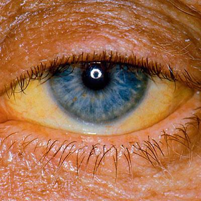 Синдром Жильбера