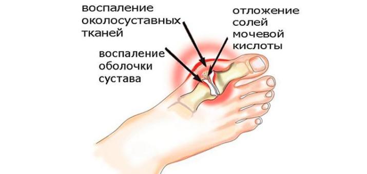 Подагра: признаки и лечение «болезни богатых людей»