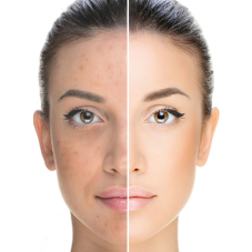 Биоревитализация: секрет вашей молодости