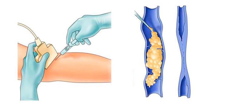 Склерозирование вен: особенности метода лечения варикоза