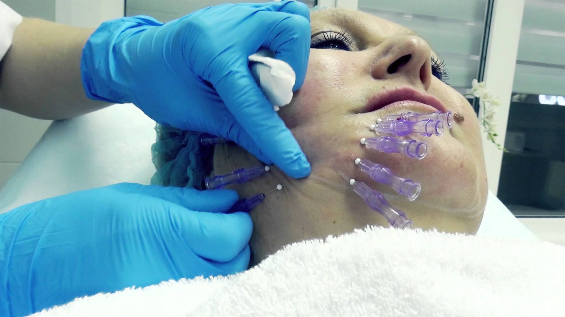 Мезонити: особенности метода подтяжки лица