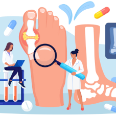 Артроз плюснефалангового сустава