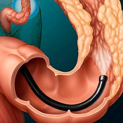 Доброкачественные новообразования прямой кишки