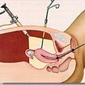 Лапароскопия яичников