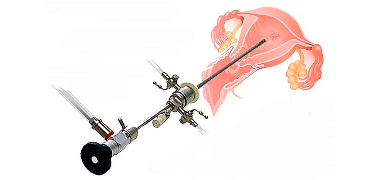 Гистерорезектоскопия: современный метод лечения заболеваний матки