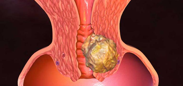 Конизация шейки матки