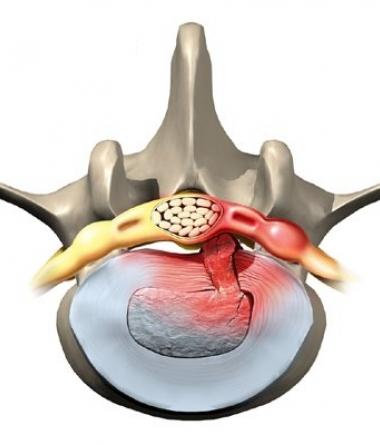 Грыжа диска