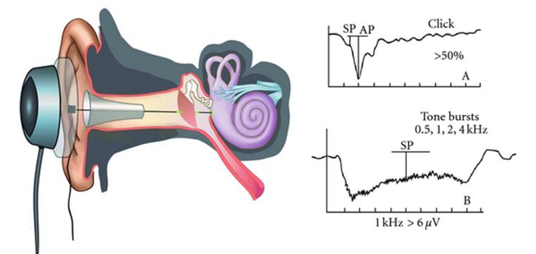 Электрокохлеография: что это такое, показания