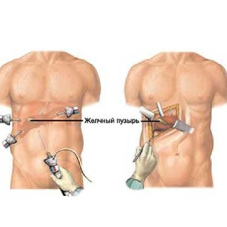 Камни в желчном пузыре: варианты лечения