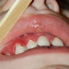 Заболевания полости рта и десен