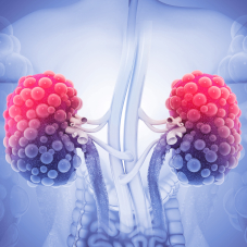 Поликистоз почек