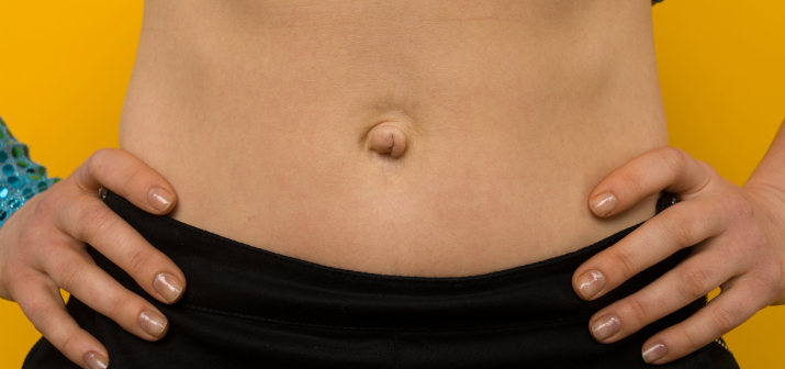 Пупочная грыжа