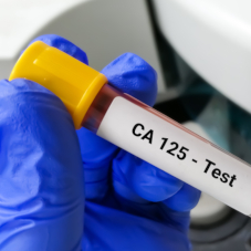 Онкомаркеры рака молочной железы