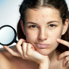 Комплексное лечение акне