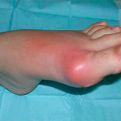 Подагра: признаки и лечение «болезни богатых людей»