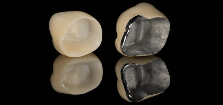 Коронки из металлокерамики, керамики (E-max) и циркония