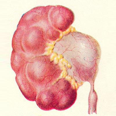 Гидронефроз: особенности заболевания почек