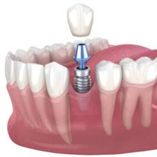 Всё, что нужно знать про одномоментную имплантацию зубов