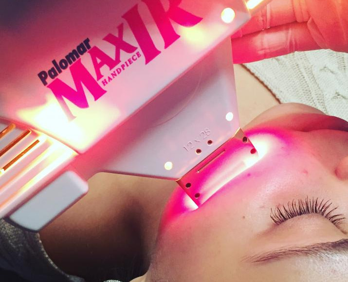 Лазерный глубокий инфракрасный фракционный термолифтинг на Palomar