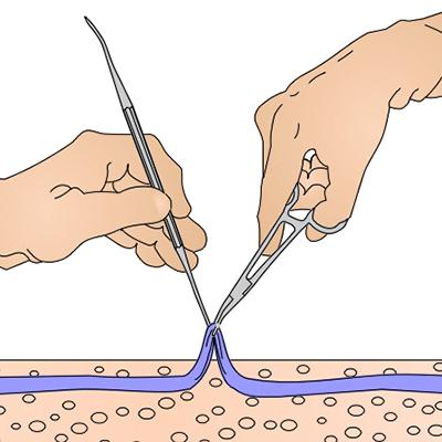 Флебэктомия: особенности метода лечения варикоза