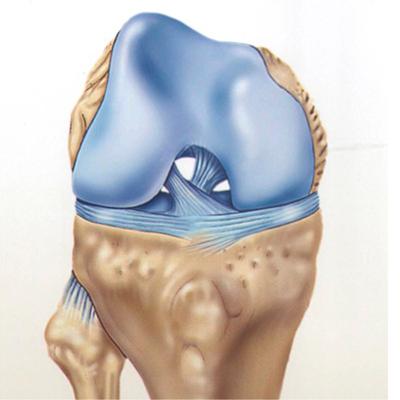 Разрыв передней крестообразной связки (ПКС)