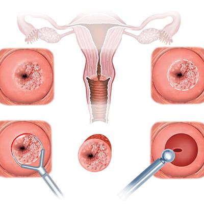 Конизация шейки матки