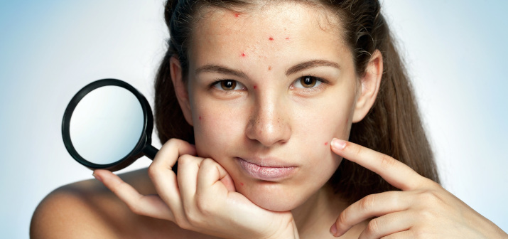 Комплексное лечение акне