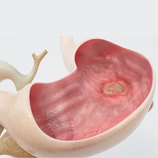 Язва желудка