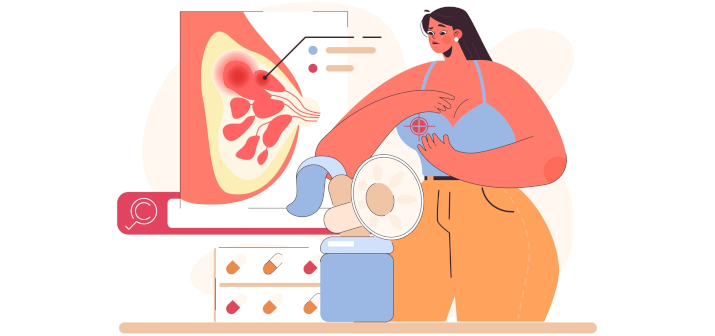 Гнойный мастит