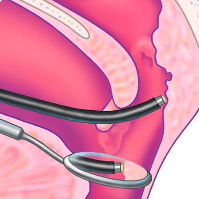 Лечение аденоидов у взрослых
