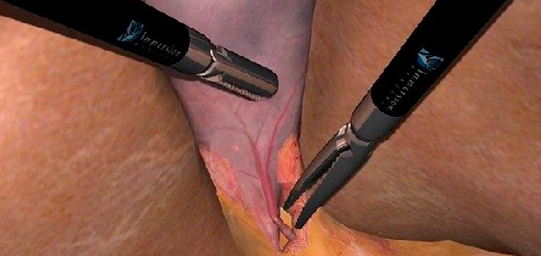 Холецистэктомия из мини-доступа