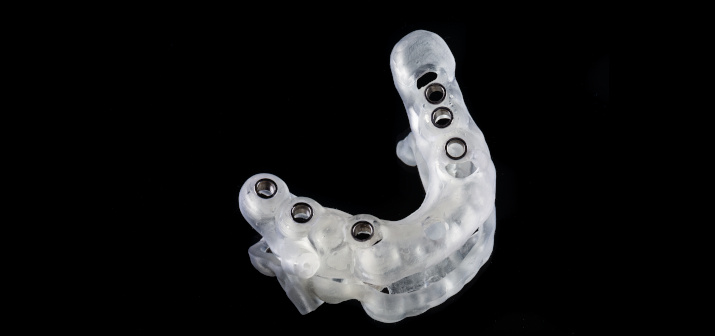 Хирургические шаблоны при имплантации зубов