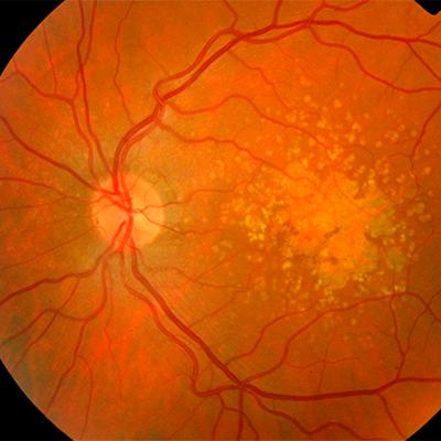 Дистрофия сетчатки: виды заболеваний