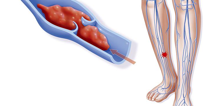 Что такое тромбофлебит и как его лечить