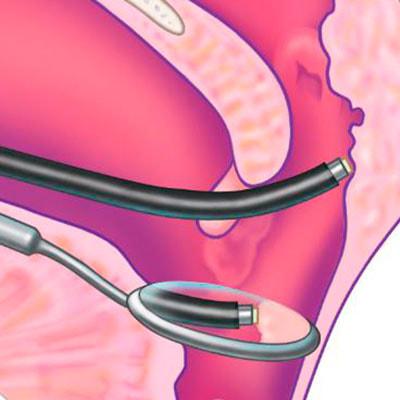 Аденотомия