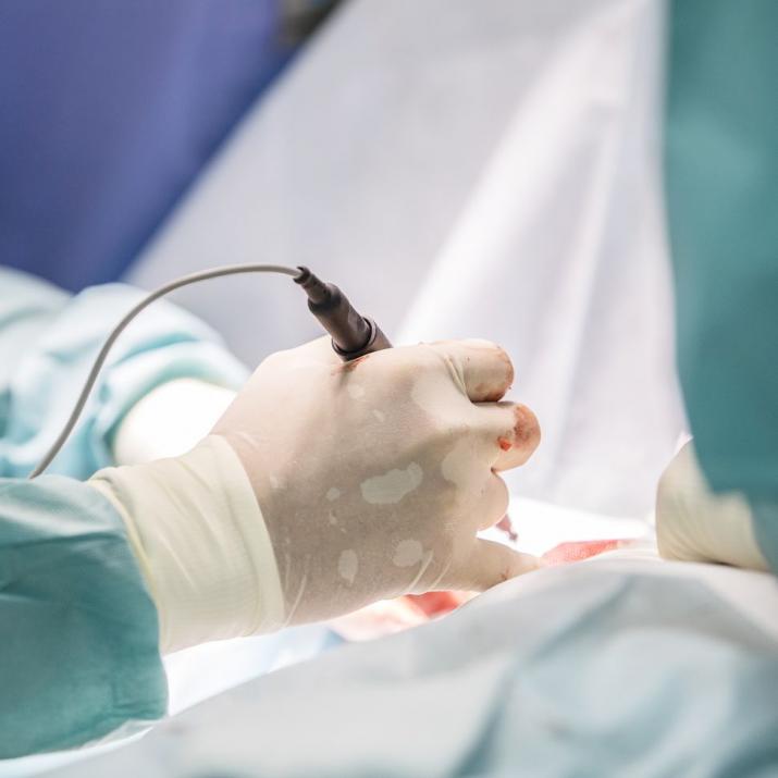 Лазерное удаление трещины прямой кишки