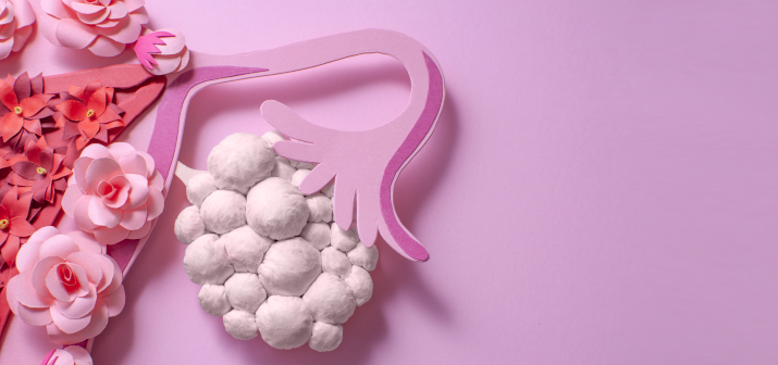 Киста яичника