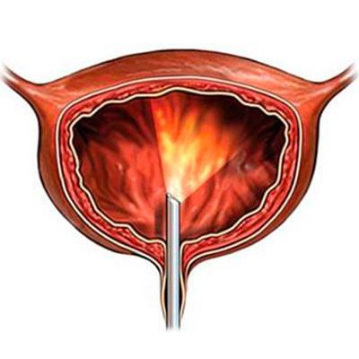 Пузырно-мочеточниковый рефлюкс: как избавиться от ПМР
