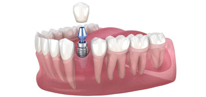 Всё, что нужно знать про одномоментную имплантацию зубов