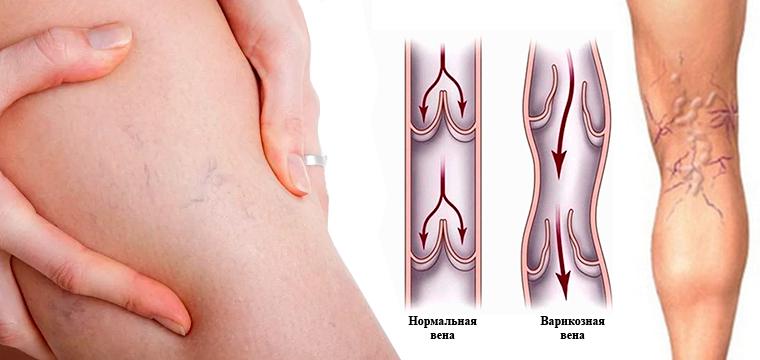 УЗИ вен: варикоз легче предупредить, чем лечить