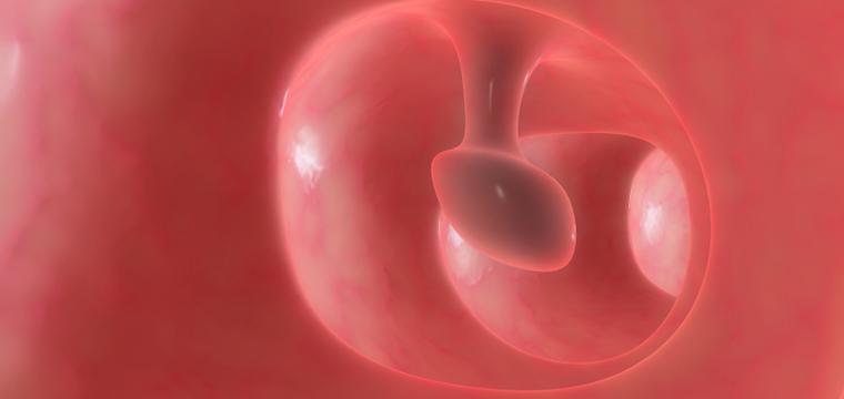 Полипы уретры: причины, симптомы, лечение доброкачественных новообразований