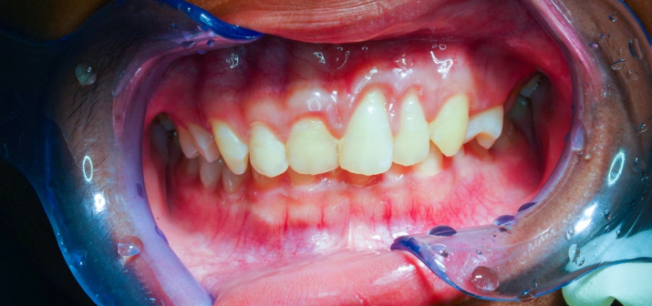 Заболевания пародонта