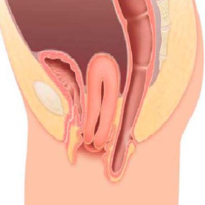 Опущение матки и стенок влагалища