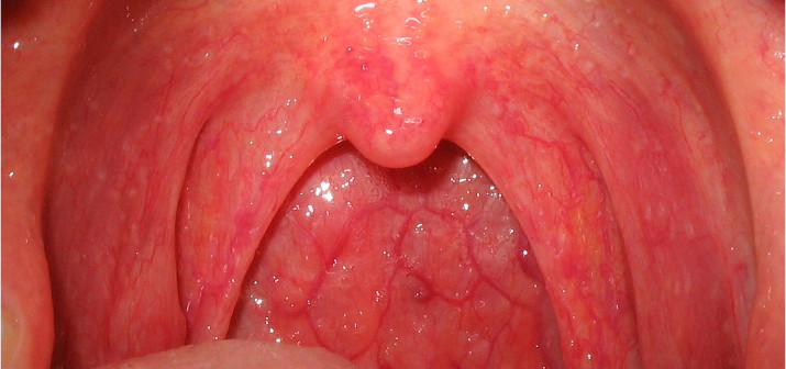 Фарингит: симптомы и лечение воспаления слизистой оболочки глотки