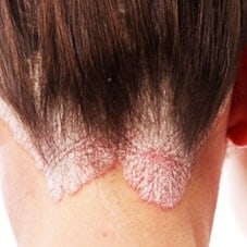 Псориаз: приговор или нет?