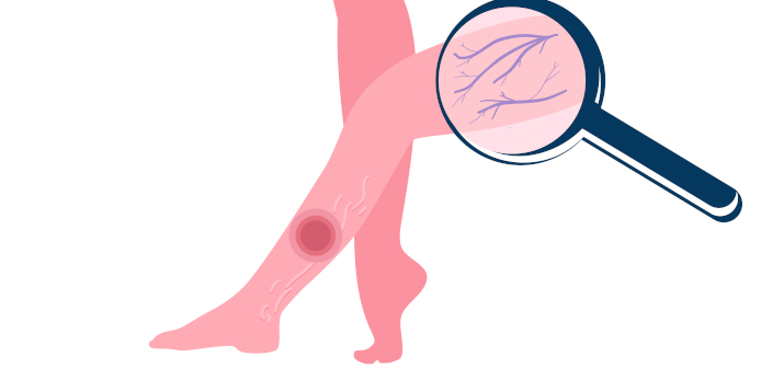 Лечение варикоза лазером