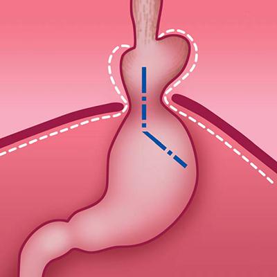 Грыжи пищевода: типы, симптомы, лечение