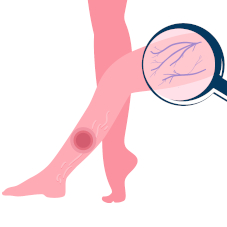 Лечение варикоза лазером